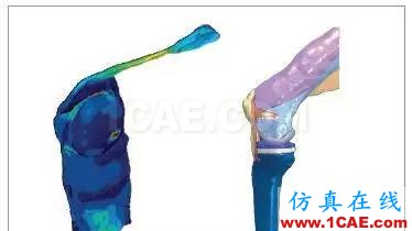 有限元醫(yī)學(xué)應(yīng)用案例：全膝關(guān)節(jié)置換術(shù)后通過對股四頭肌肌力進(jìn)行計算分析來改善患者的膝關(guān)節(jié)屈曲度hypermesh學(xué)習(xí)資料圖片2