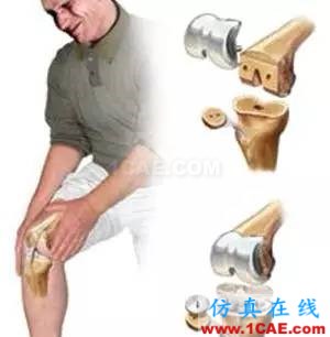 有限元醫(yī)學(xué)應(yīng)用案例：全膝關(guān)節(jié)置換術(shù)后通過對股四頭肌肌力進(jìn)行計算分析來改善患者的膝關(guān)節(jié)屈曲度hypermesh技術(shù)圖片6