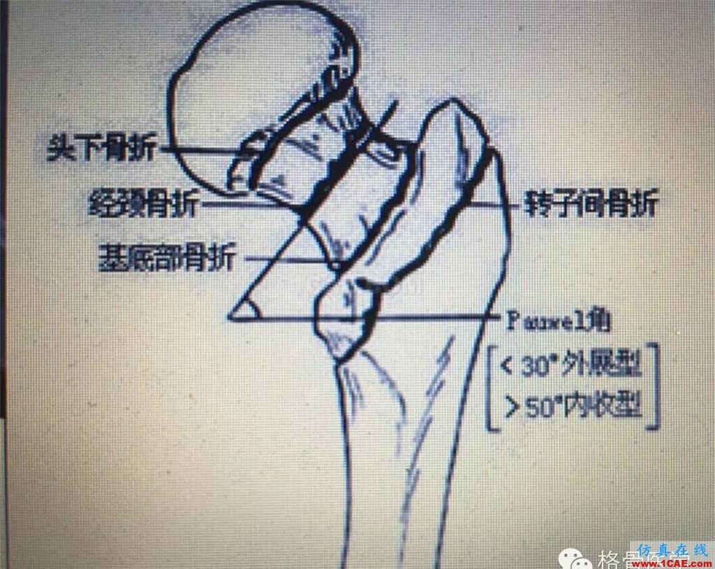 “倒品字”與“品字”空心釘不同Pauwels分型骨折的生物力學性能研討ansys仿真分析圖片2
